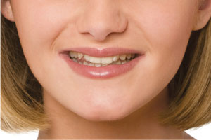 before Snap-On Smile to enhance smile