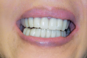 after Snap-On Smile - Missing Teeth