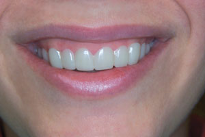 after custom fitted Snap-On Smile