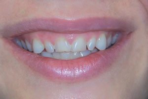 before custom fitted Snap-On Smile