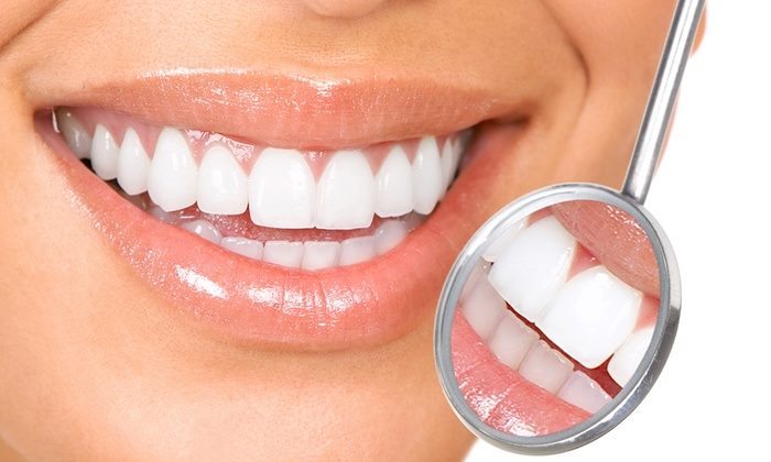 results after professional teeth whitening services
