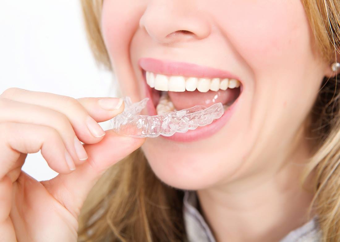affordable ClearCorrect aligners in Sydney