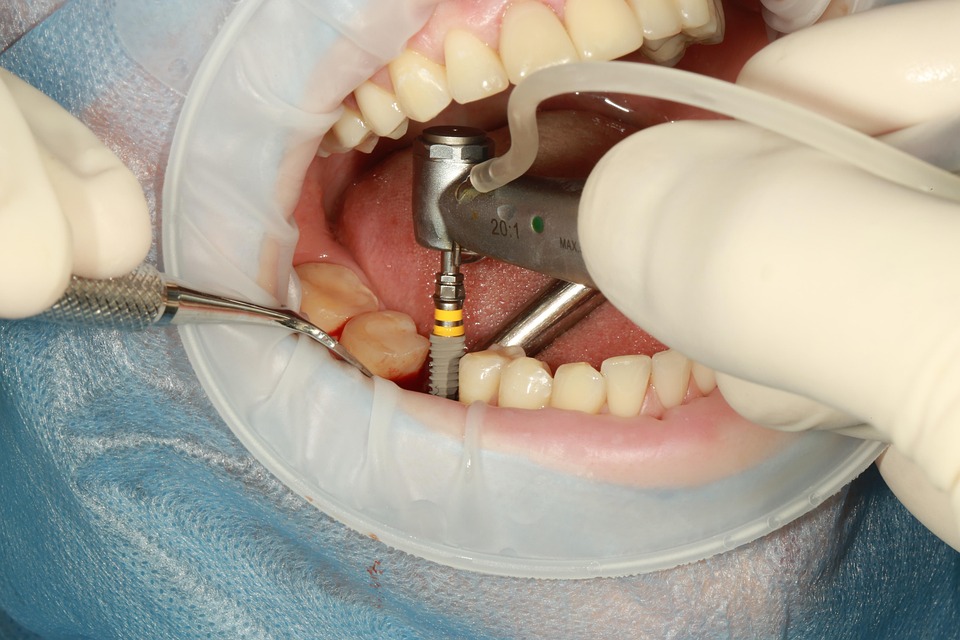 Dental Implant myths