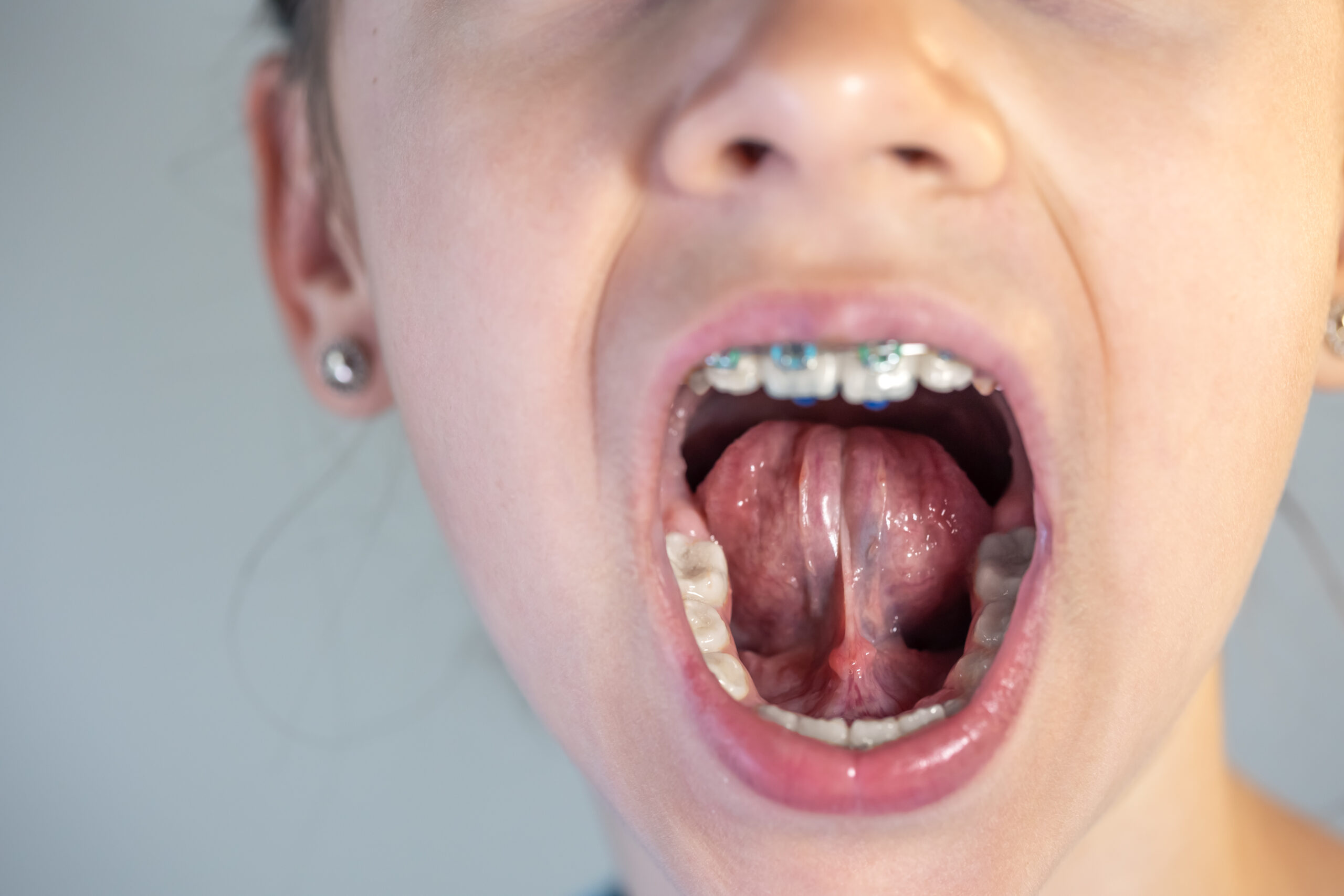 frenectomy cost